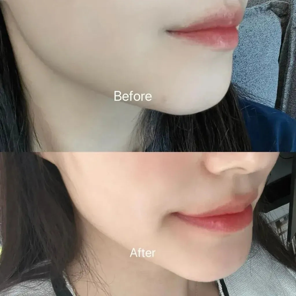 BR:LAB Tea Tree Super Acne Spot Remover 10ml
