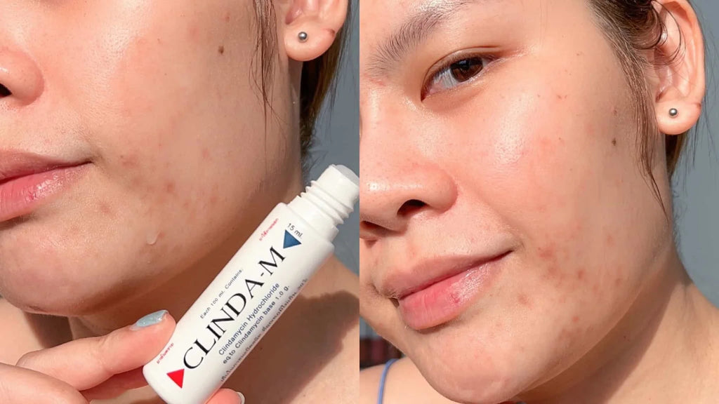 CLINDA M Acne Water 15ml