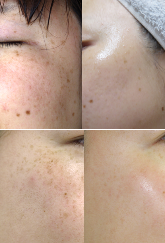 DongSung 韓國 琅絲曲酸去斑面霜 70g