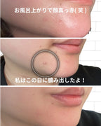 Sevitab Vitamin B3 Skin Treatment Acne Care Gel 18g