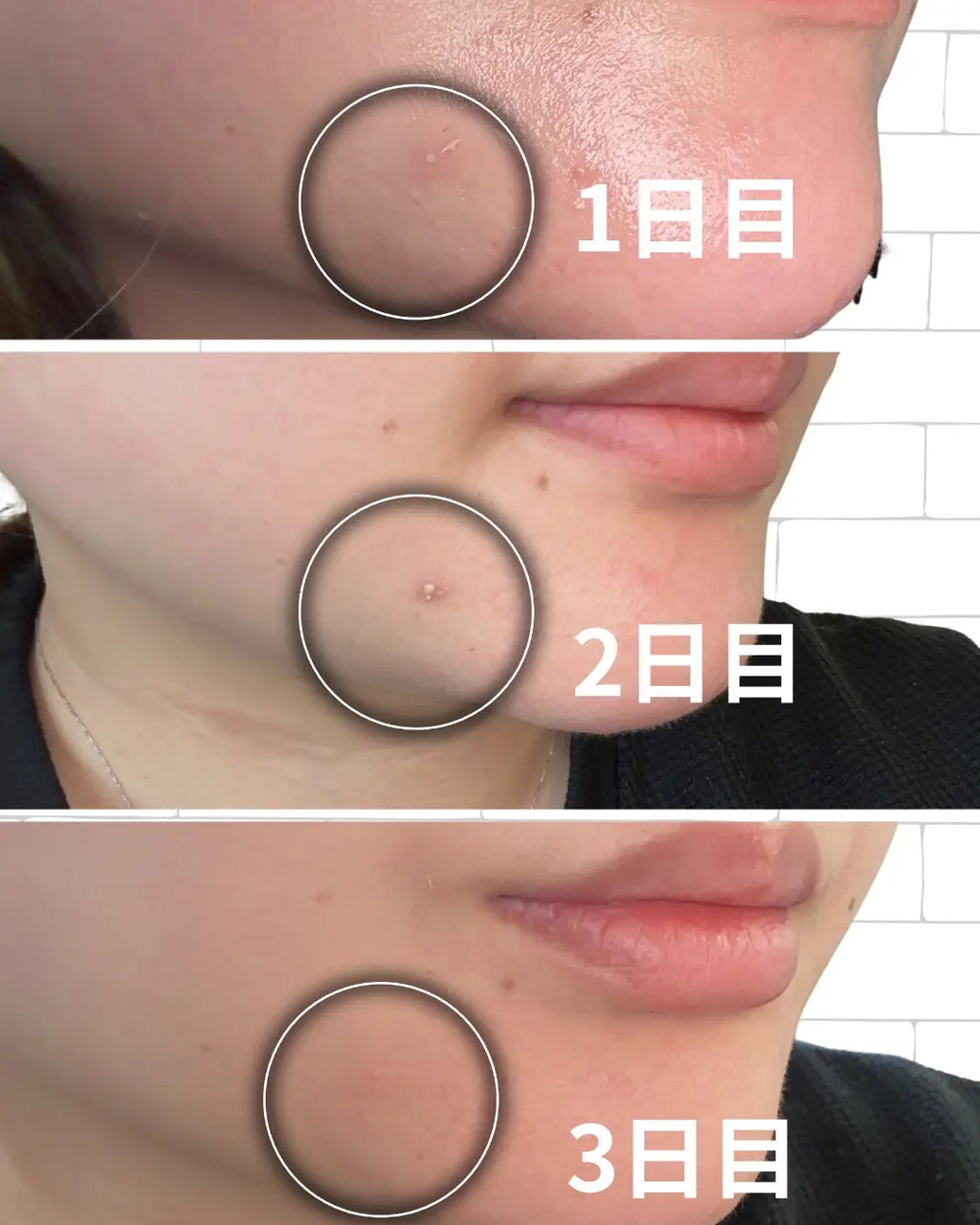 Sevitab Vitamin B3 Skin Treatment Acne Care Gel 18g