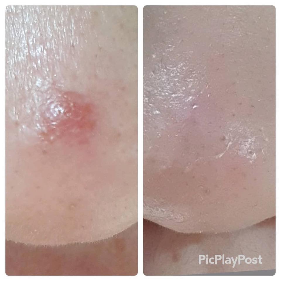 Handok Clearteen Topical Acne Treatment 30ml