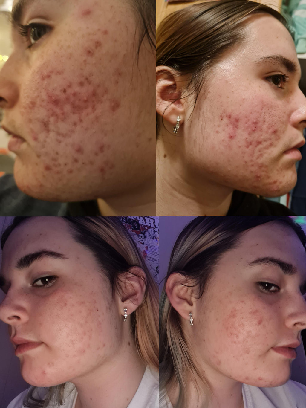 Benzac Medicated Acne Gel 5% AC 60g