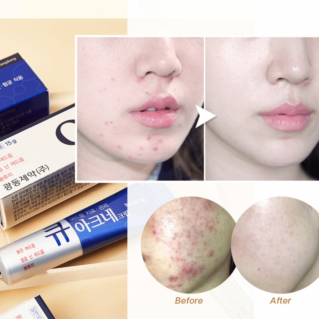 Kwangdong Q Acne Plus Cream 15g