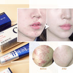 Kwangdong Q Acne Plus Cream 15g