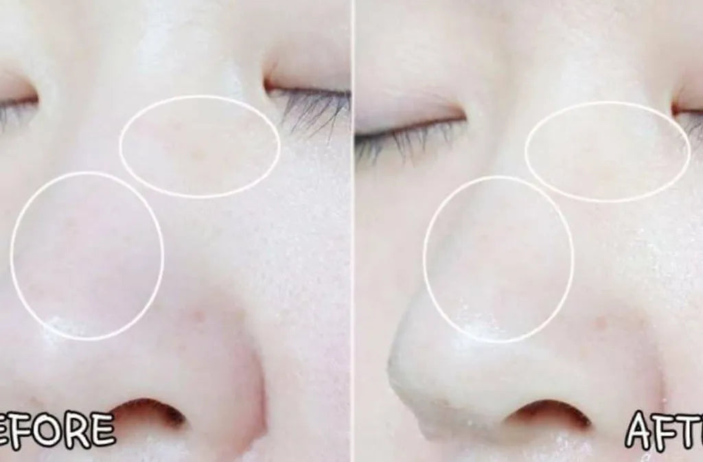 Dong-A Pharm Upgraded Version Melanosa Cream (4% Hydroquinone for Melasma, Freckles & Dark Spots) 30g