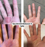 GC Biopharma 韓國 Nobason 快速緩解發炎乳膏 15g