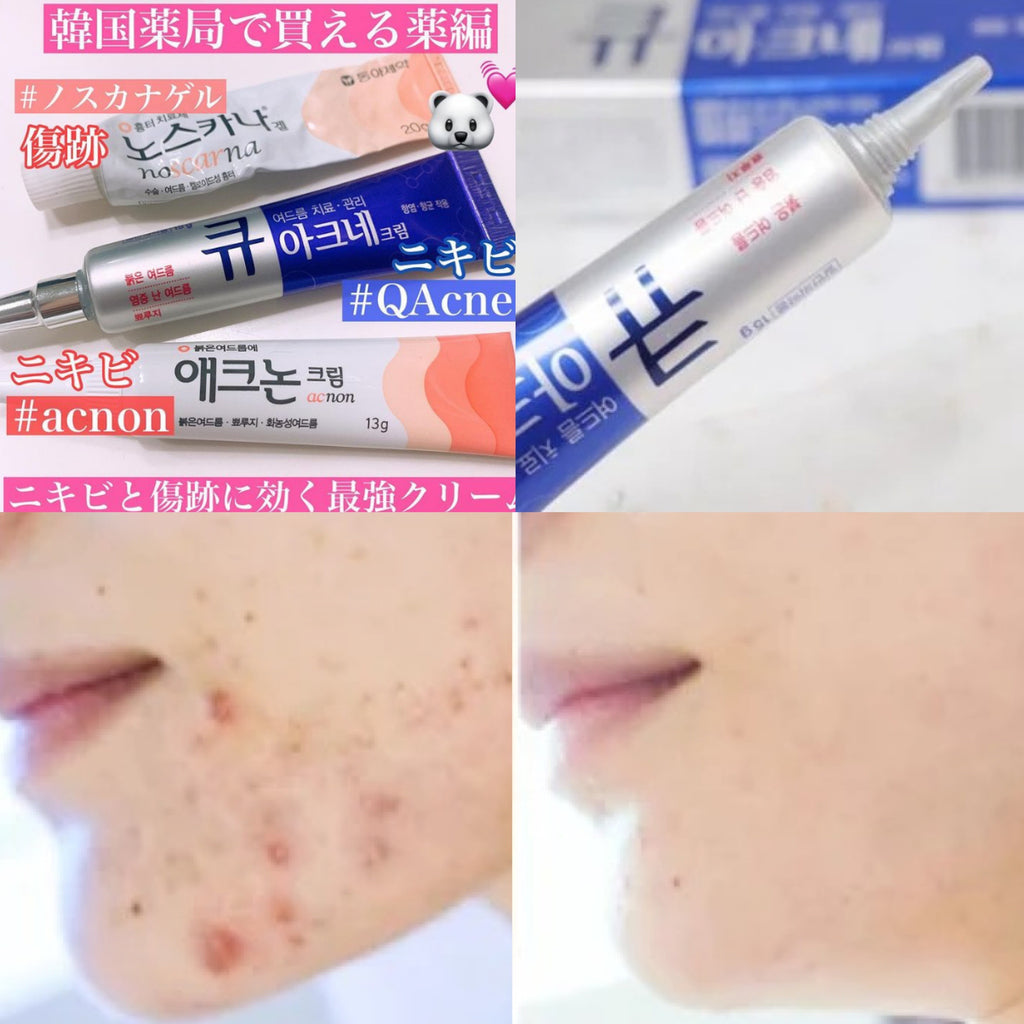 Kwangdong Q Acne Plus Cream 15g