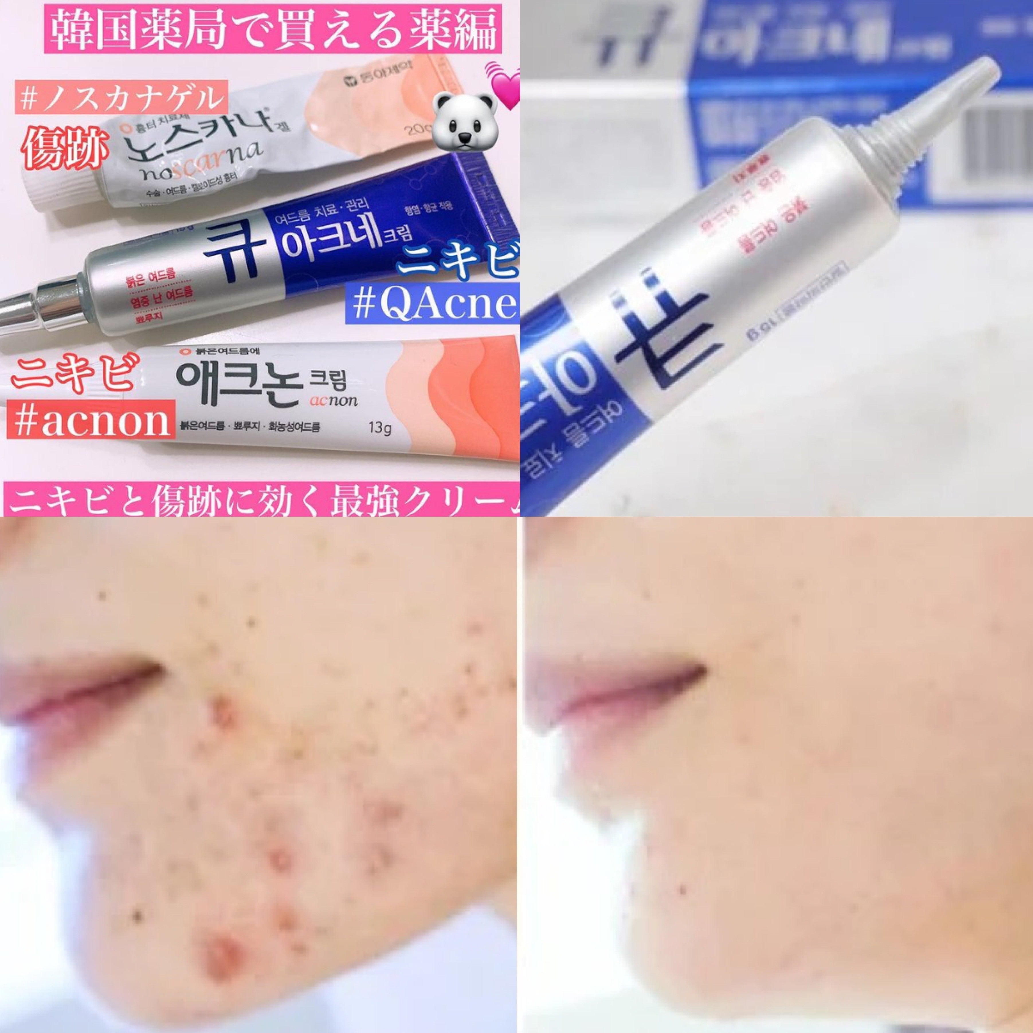 Kwangdong Q Acne Plus Cream 15g