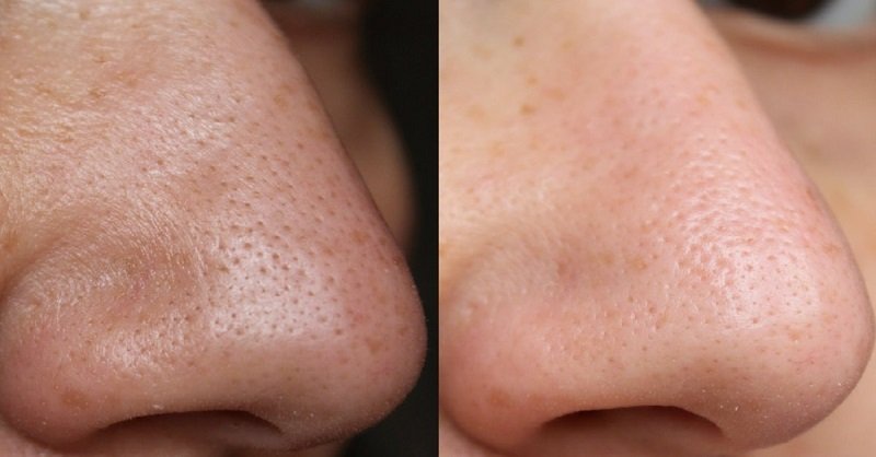 Medipeel Extra Super 9 Plus 2.0 (Upgraded Version) 1000ml