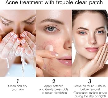 CURESYS Trouble Clear Needle Patch (14mm) 9ea