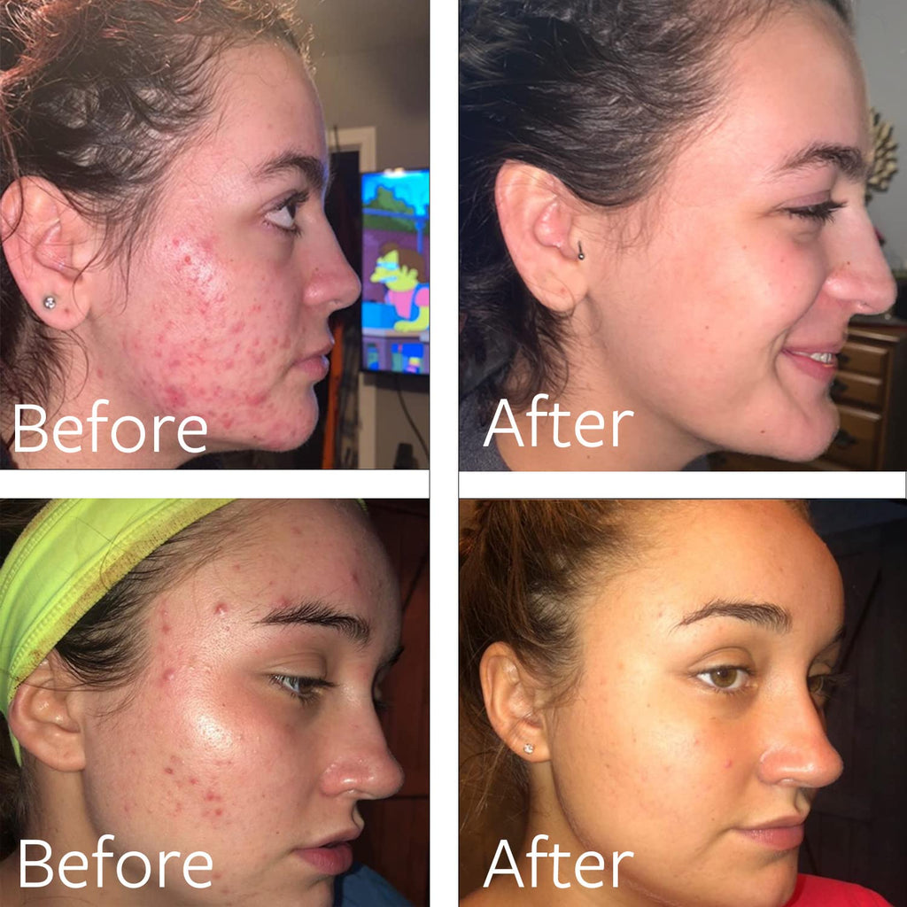 Benzac Medicated Acne Gel 5% AC 60g