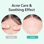 BRING GREEN Zinc Teca™ 1.2% Blemish Serum 25ml