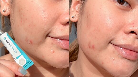TOMEI Clindai Gel (Topical Antibiotic For Acne) 5g