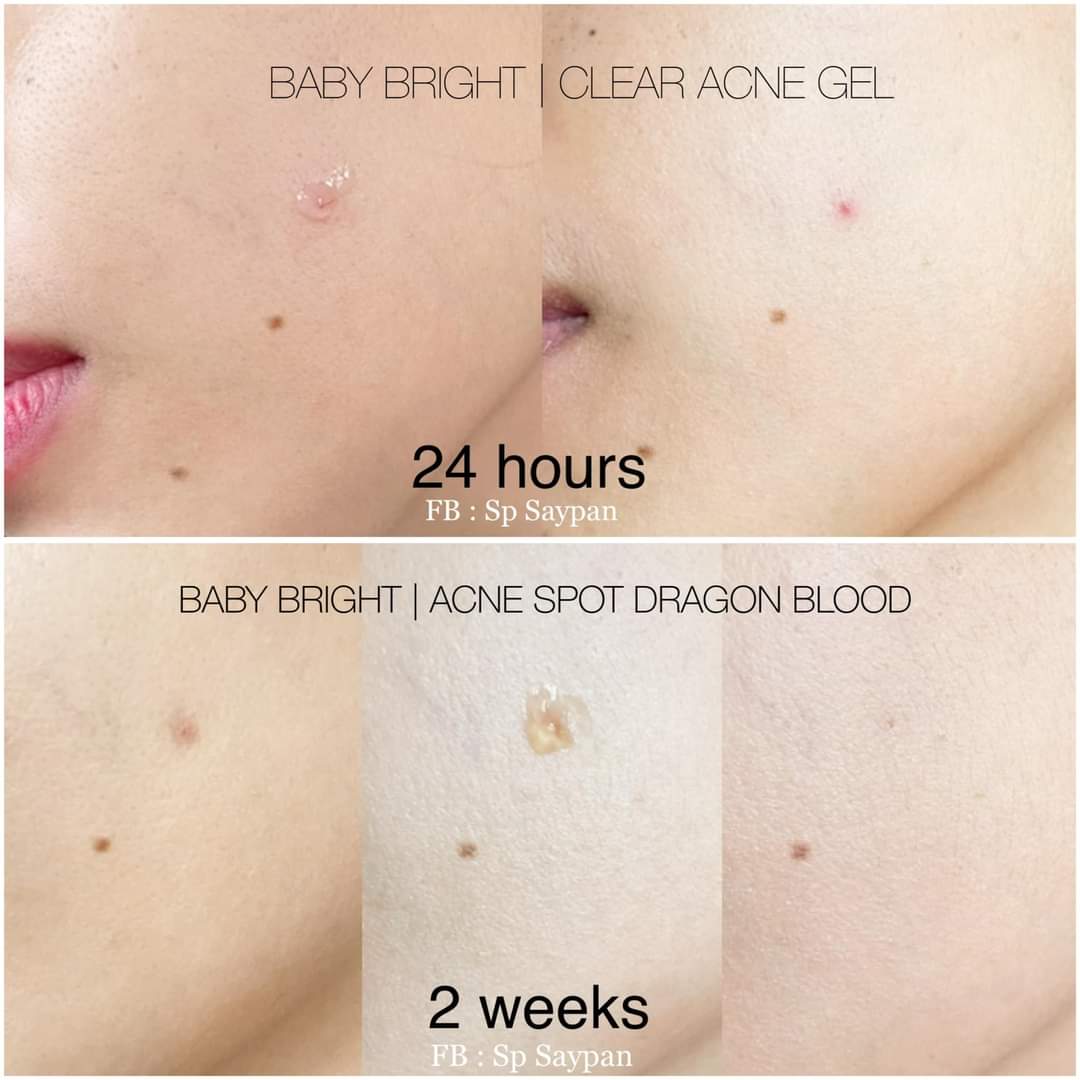 Baby Bright 2% Salicylic Acid Clear Acne Clearing Gel 15g