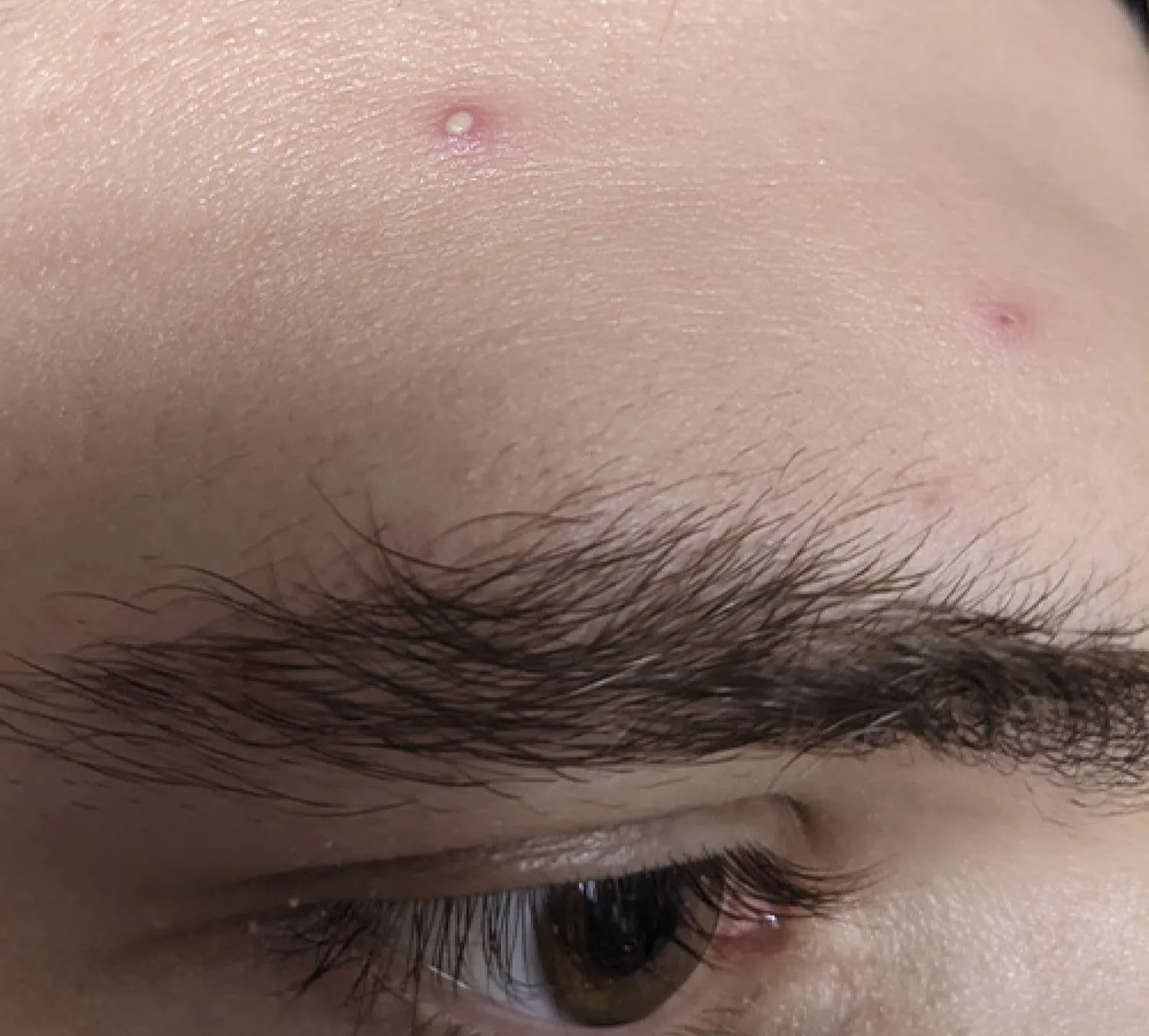 PanOxyl 抗痘控油 淨膚泡沫潔面乳 156g
