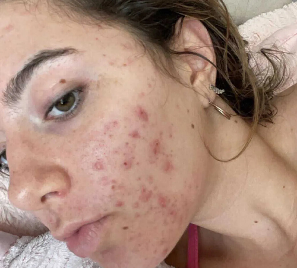 PanOxyl 抗痘控油 淨膚泡沫潔面乳 156g
