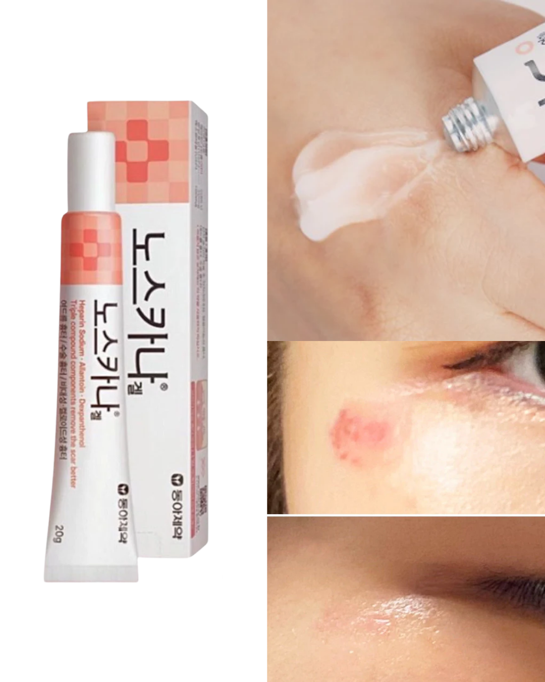 Dong-A Pharm Noscarna Scar Gel (Treat Keloid, Surgery & Acne Scars) 20g