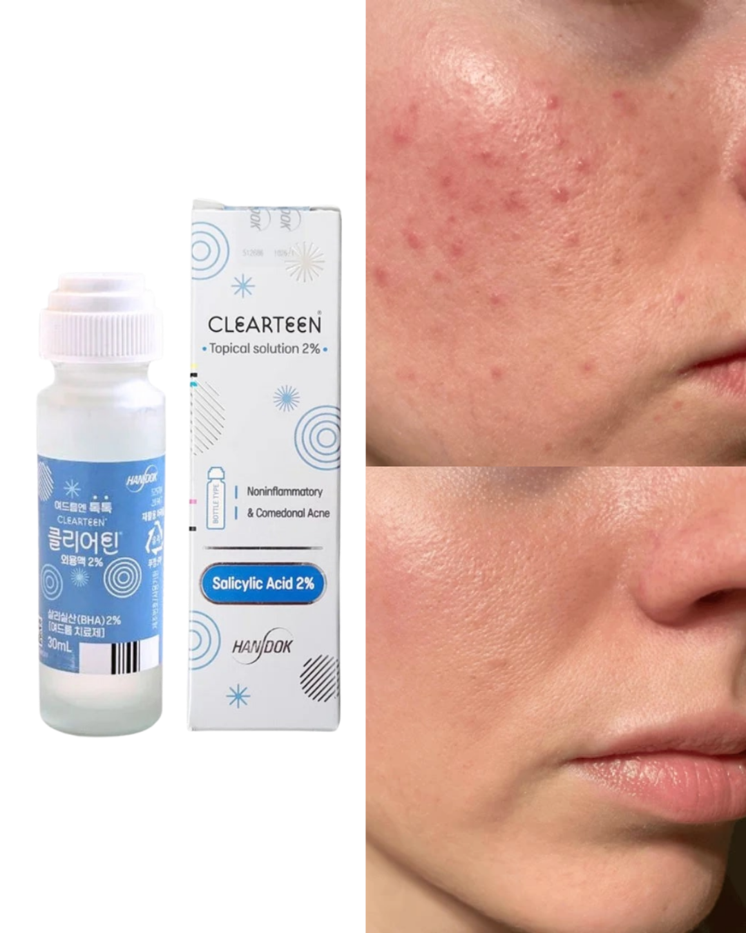 Handok Clearteen Topical Acne Treatment 30ml