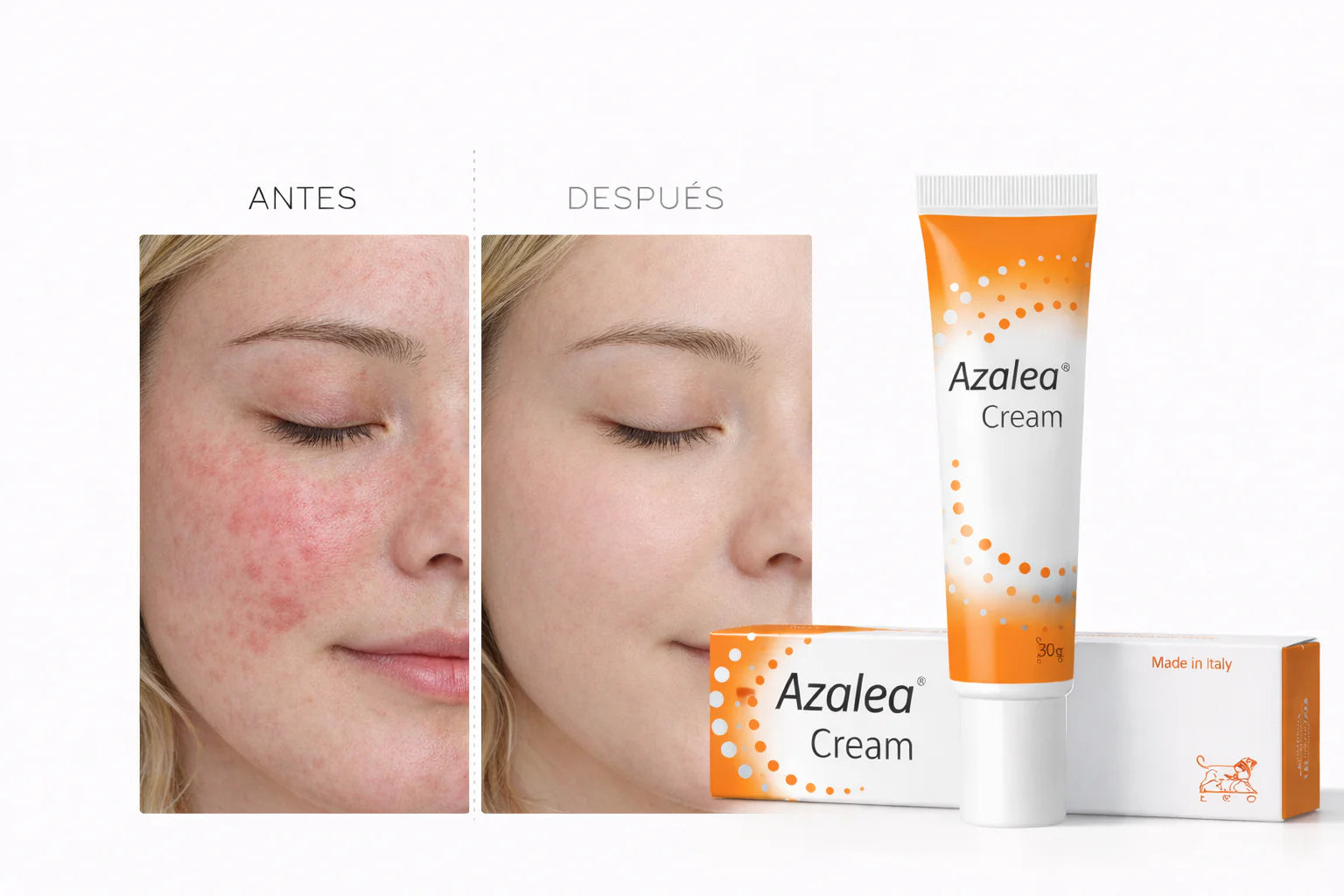 LEO Pharma Azalea Acid 20% Cream (Comedonal Acne) 30g