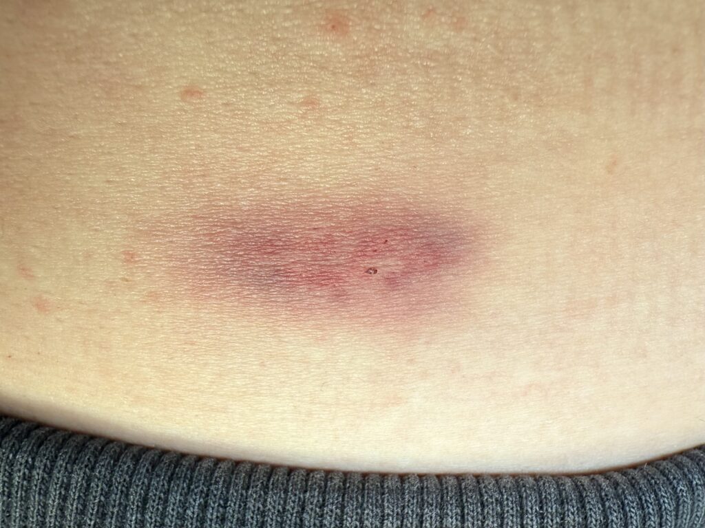 LG Bentpla Gel (Relieves Pain and Discomfort) 15g