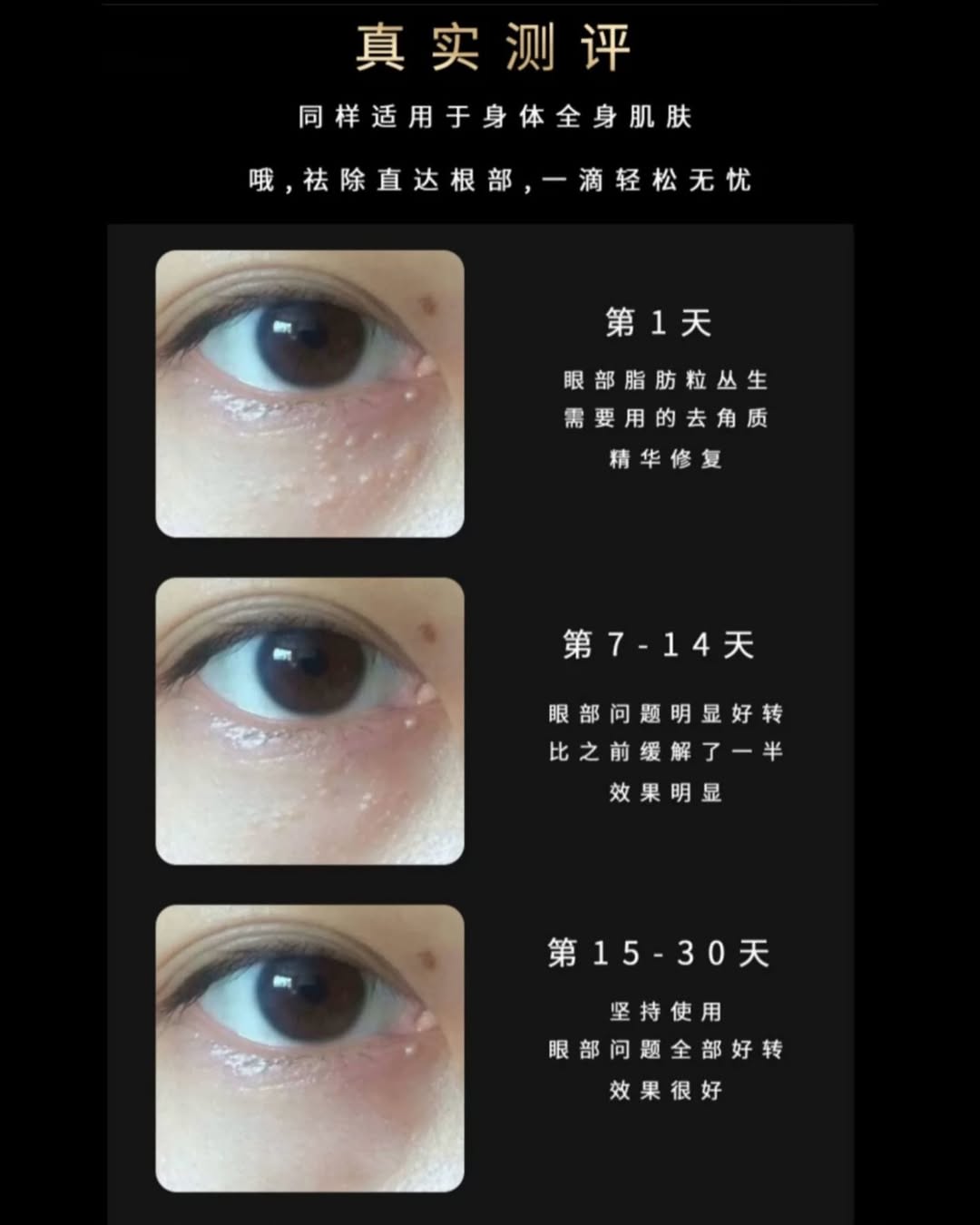 Ipocare  日本 EX 強效除疣專用美容液 18ml