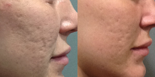 Clindalin gel For Acne 10g
