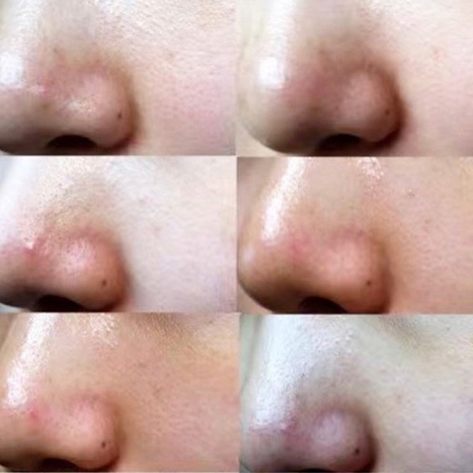 Handok Clearteen Topical Acne Treatment 30ml