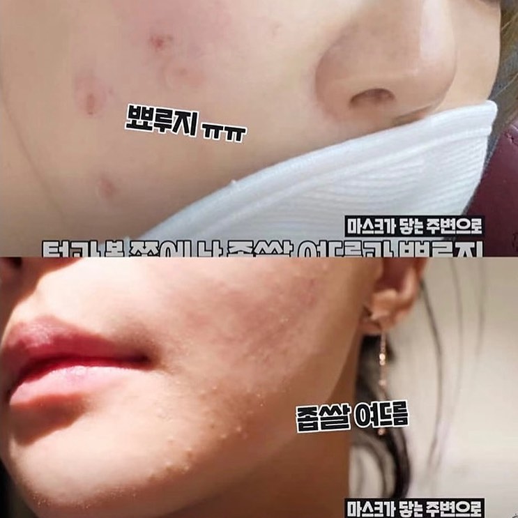 Handok Clearteen Topical Acne Treatment 30ml