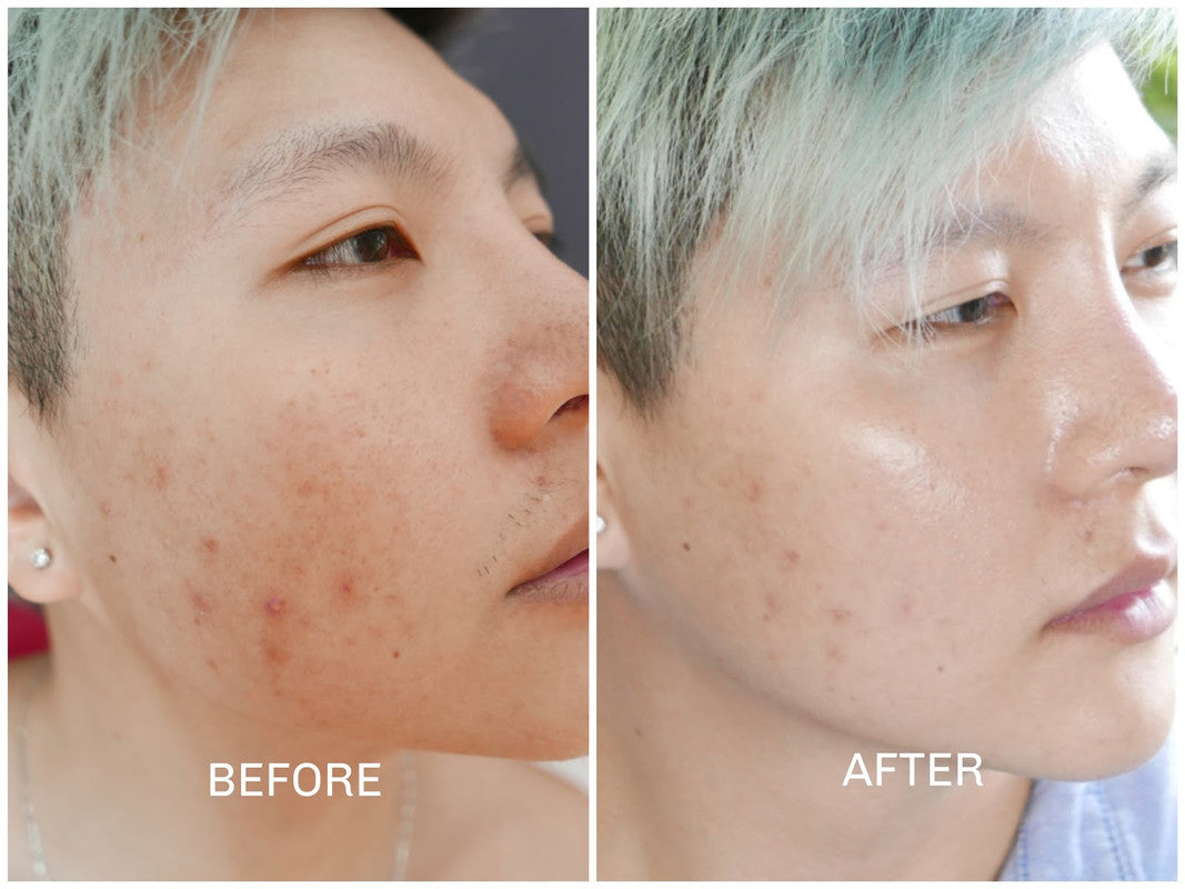 Yanhee Acne Cream 10g