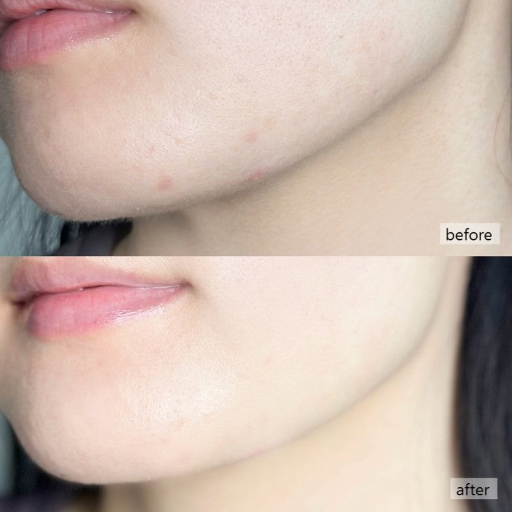 Dong-A Pharm Spot Solution Acne Pro Cream 30ml