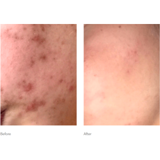 Benzac Medicated Acne Gel 5% AC 60g