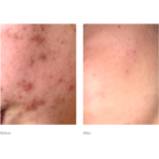 Benzac Medicated Acne Gel 5% AC 60g