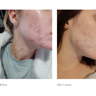 Benzac Medicated Acne Gel 5% AC 60g