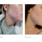 Benzac Medicated Acne Gel 5% AC 60g