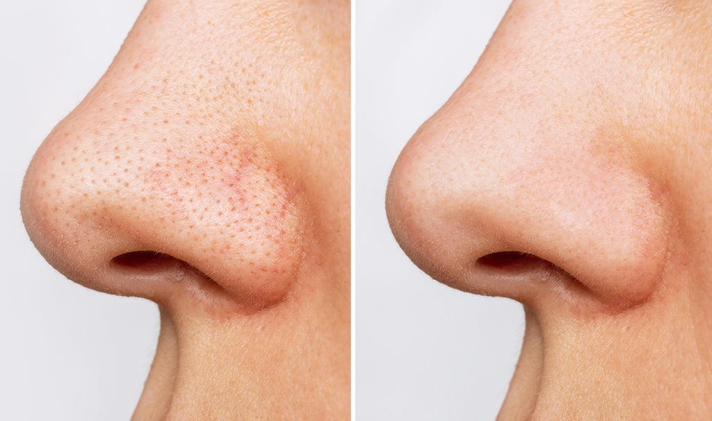 CLEAR NOSE Tea Tree Alcohol-Free Acne Gel Concentrate Solution 4g/15g