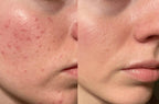 Japan Rabbit Annasalbe Sulfur Formula Acne Care & Pimple Recovery Cream 18g