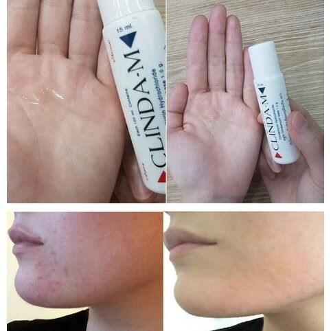 CLINDA M Acne Water 15ml