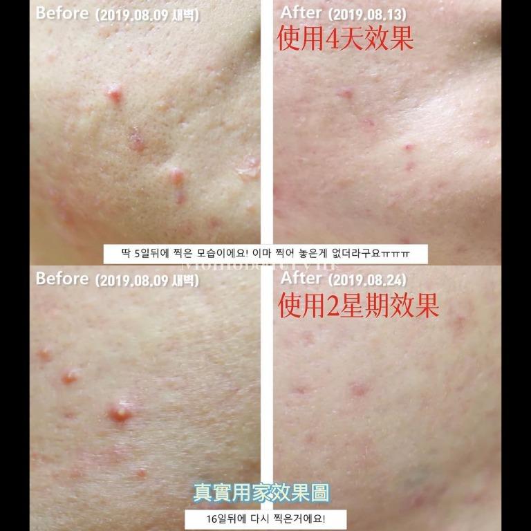 Handok Clearteen Topical Acne Treatment 30ml