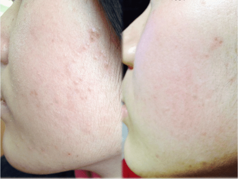 Yanhee Acne Cream 10g