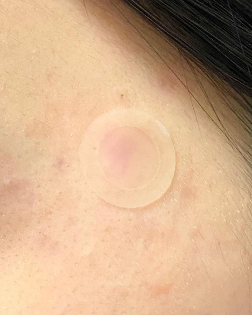 CURESYS Trouble Clear Needle Patch (14mm) 9ea