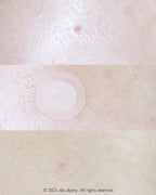 CURESYS 韓國 微針修復淨痘貼 (14mm) 9片