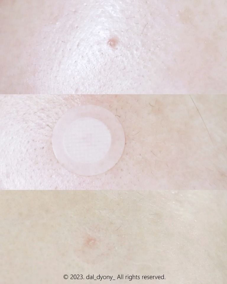 CURESYS Trouble Clear Needle Patch (14mm) 9ea