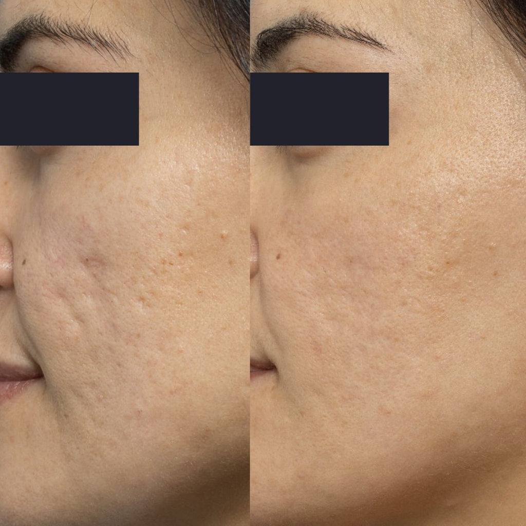 Clindalin gel For Acne 10g