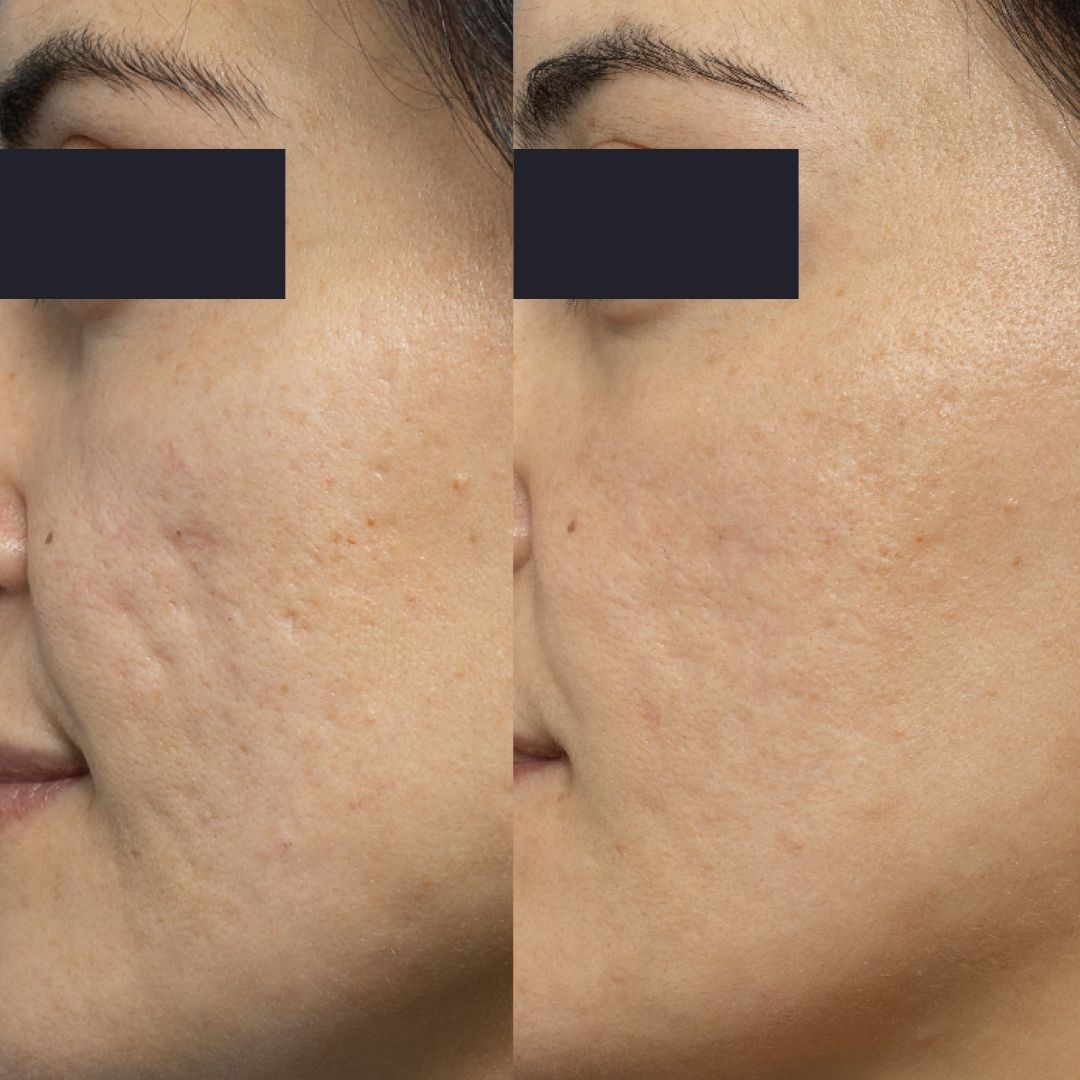 Clindalin gel For Acne 10g
