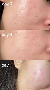 VT COSMETICS Reedle Shot 100 Pore & Texture Refining Essence 50ml