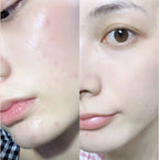 Dong-A Pharm Acnon Cream 13g