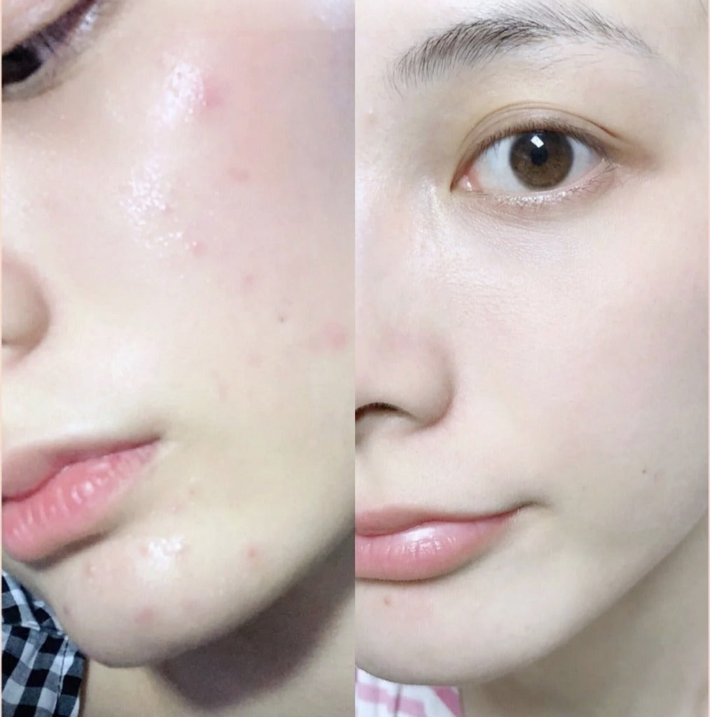 Dong-A Pharm Acnon Cream 13g