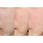 Yanhee Acne Cream 10g