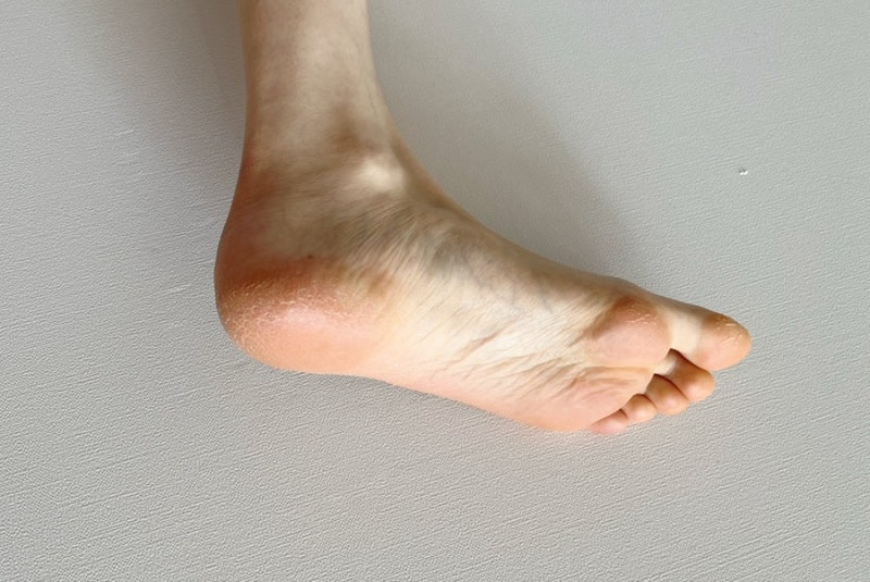 Hanmi 韓國 PRO-CALM 強效醫美手腳裂膏 50g